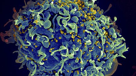 This electron microscope image made available by the U.S. National Institutes of Health shows a human T cell, in blue, under attack by HIV, in yellow, the virus that causes AI