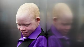 Ouganda : une ONG pour soutenir les albinos