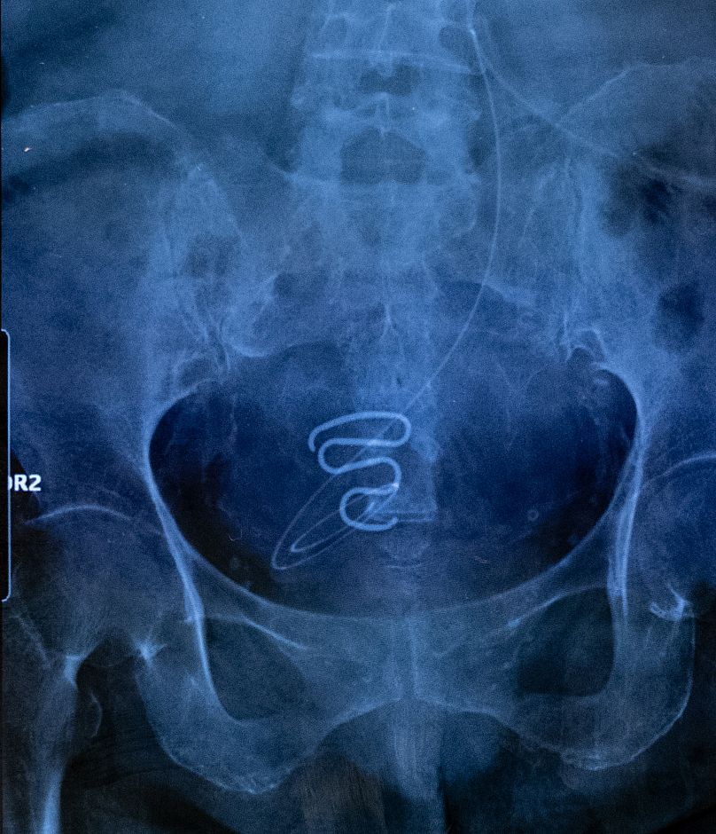 Une radiographie montrant un DIU ou un stérilet - communément appelé "spirale".