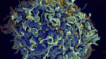 This electron microscope image shows a human T cell, in blue, under attack by HIV, in yellow, the virus that causes AIDS.