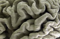 A section of a human brain with Alzheimer's disease is displayed at the Museum of Neuroanatomy at the University at Buffalo.