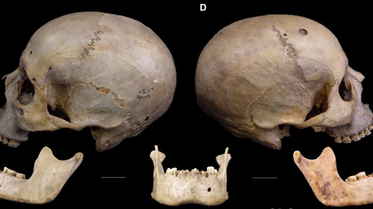 Il cranio di 4mila anni fa porta tracce di quello che potrebbe essere il primo trattamento antitumorale della storia