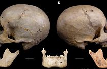 The 4,000-year-old skull bears traces of what could be the earliest cancer treatment ever.