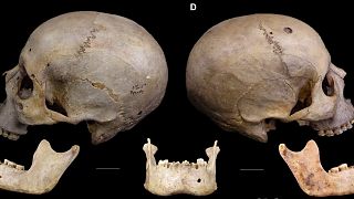 O crânio com 4.000 anos de idade tem vestígios do que poderá ser o tratamento mais antigo de sempre contra o cancro.