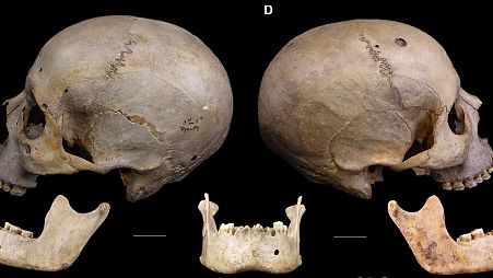 The 4,000-year-old skull bears traces of what could be the earliest cancer treatment ever.