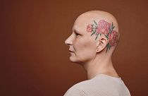 خالکوبی بر روی سر یک فرد مبتلا به سرطان