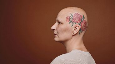 خالکوبی بر روی سر یک فرد مبتلا به سرطان