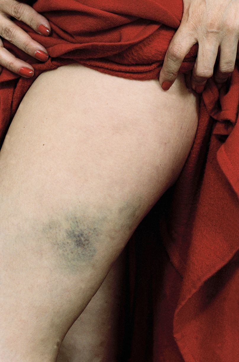 Susan Meiselas Γυναίκα με μελανιά, θύμα ενδοοικογενειακής βίας, Σαν Φρανσίσκο, 1992. 