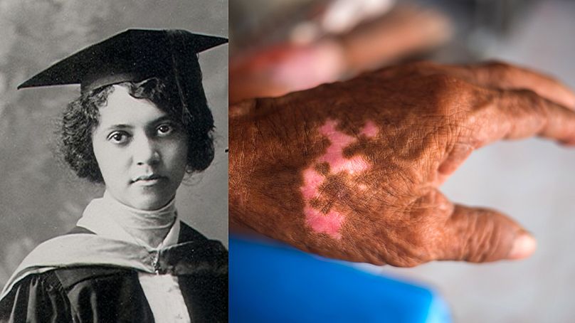 Alice Ball e a mão de uma pessoa infetada com lepra