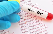 An example of a herpes test.
