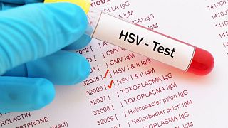 An example of a herpes test.