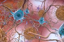 Sejtek egy Alzheimer-kórban szenvedő agyban