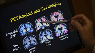  Un medico indica i risultati di una scansione PET che fa parte di uno studio sulla malattia di Alzheimer presso il Georgetown University Hospital.