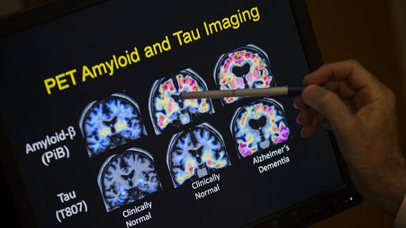  A doctor points to PET scan results that are part of a study on Alzheimer's disease at Georgetown University Hospital.