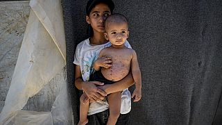 Gaza war: Skin diseases spread among children in overcrowded camps