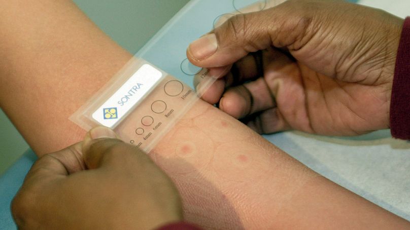 A study trial subject has the spots on her arm measured to determine the absorption of the flu vaccine administered with a new procedure being tested.