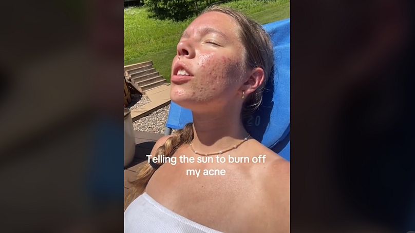 A screengrab from a video about the TikTok sunburning trend