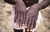 Cette image de 1997 fournie par le CDC montre les mains d'un patient atteint de mxpox, au Zaïre (devenu la République démocratique du Congo)