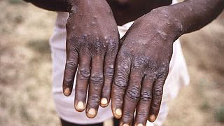 Cette image de 1997 fournie par le CDC montre les mains d'un patient atteint de mxpox, au Zaïre (devenu la République démocratique du Congo)