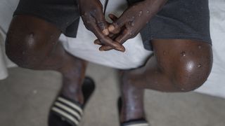 FILE - An unidentified man infected with mpox at the Goma General Hospital, Democratic Republic of the Congo, on July 16, 2024.