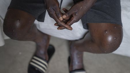 FILE - An unidentified man infected with mpox at the Goma General Hospital, Democratic Republic of the Congo, on July 16, 2024.