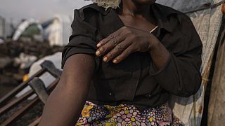 Sarah Bagheni, en el campo de refugiados de Bulengo en Goma, Congo, sospecha que puede estar infectada con Mpox