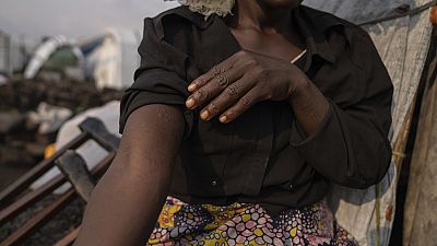 Sarah Bagheni, en el campo de refugiados de Bulengo en Goma, Congo, sospecha que puede estar infectada con Mpox