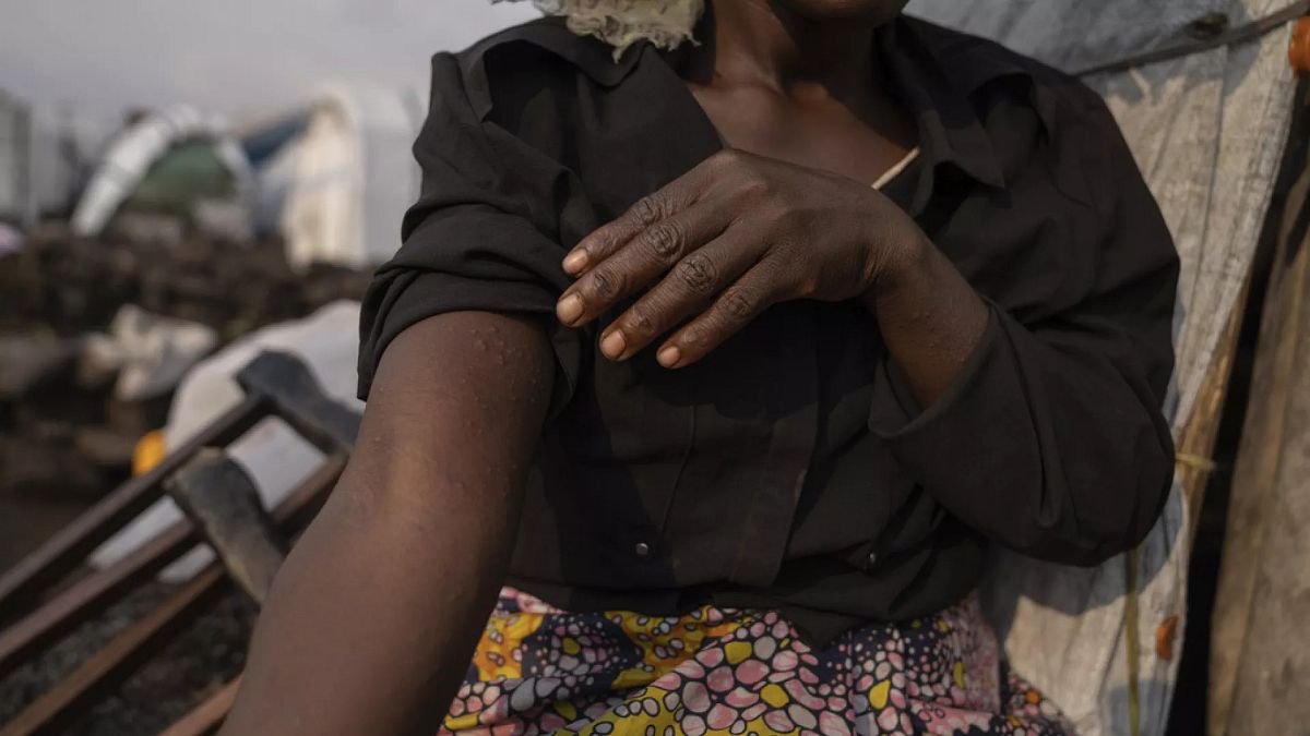 Une femme, dans le camp de réfugiés de Bulengo à Goma, au Congo, soupçonne qu'elle pourrait être infectée par le Mpox, 15 août 2024.