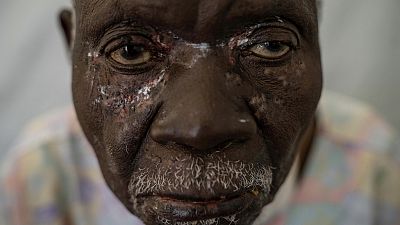 A photographer captures the mpox health crisis in Africa in a closeup