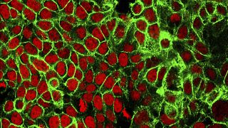 FILE - This microscope image made available by the National Cancer Institute Center for Cancer Research in 2015 shows human colon cancer cells with the nuclei stained red.