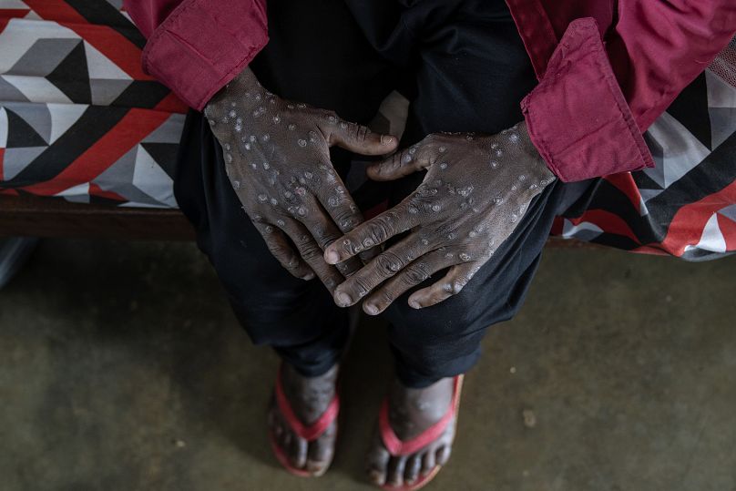 Un homme souffrant du Mpox attend d'être soigné à l'hôpital général de Kamituga, au Sud-Kivu