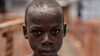 L'Afrique lance la riposte à 600 millions de dollars contre le mpox