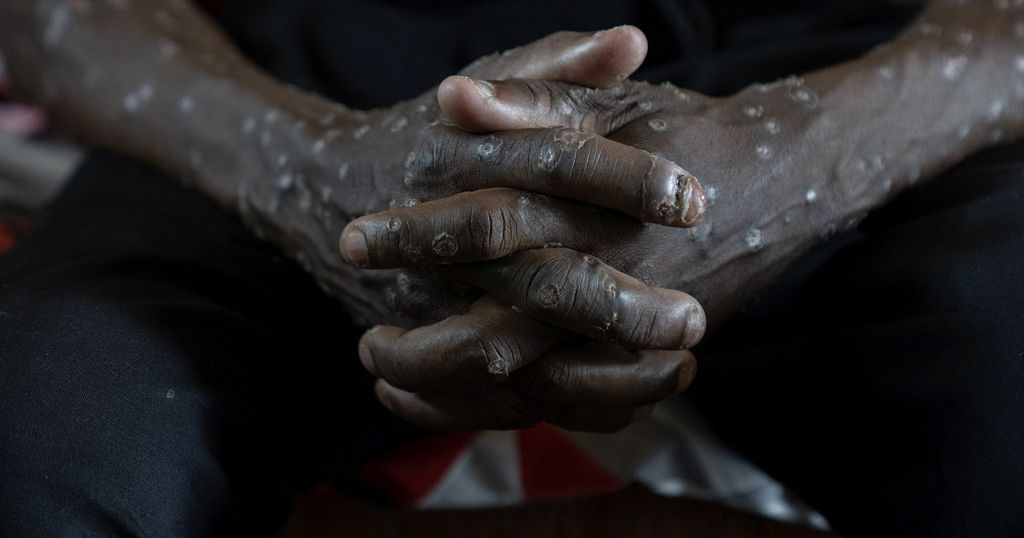 Mpox case found in Uganda prison, official says