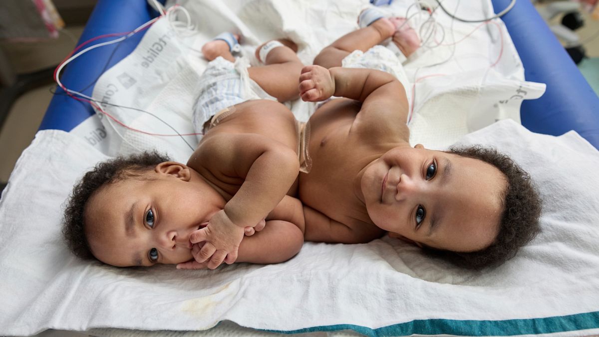 Des jumeaux siamois séparés avec succès fêtent leur premier anniversaire