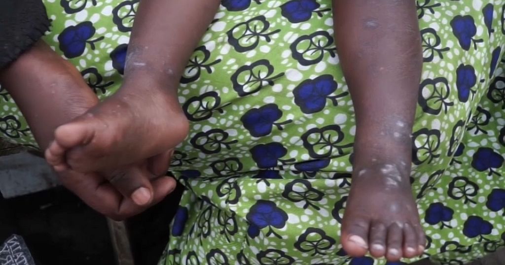 Cases of new mpox strain more than double among children in DR Congo and Burundi