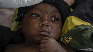 Mpox : l'épidémie en forte hausse chez les enfants en RDC et au Burundi