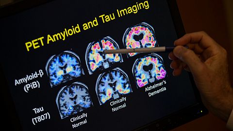 A professor points to PET scan results that are part of a study on Alzheimer's disease.