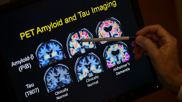 A professor points to PET scan results that are part of a study on Alzheimer's disease.