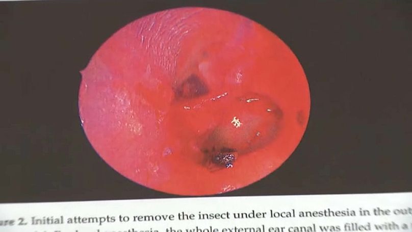 لحظات خضوع المرأة لعملية جراحية في النمسا لسحب نملة دخلت إلى أذنها الوسطى