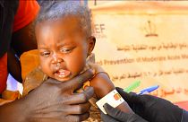 Malnourished child in Zamzam camp, Sudan, 22.11.2024