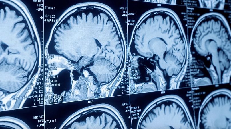 Çoğu durumda, Alzheimer'ın tek bir genetik nedeni olmazken, yaşam tarzı ve çevresel faktörlerle birlikte birden fazla genden etkilenmesi muhtemel.