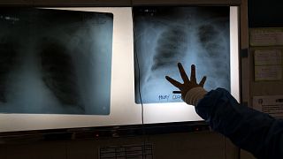 A doctor examines chest X-rays at a hospital in Peru in April 2020.