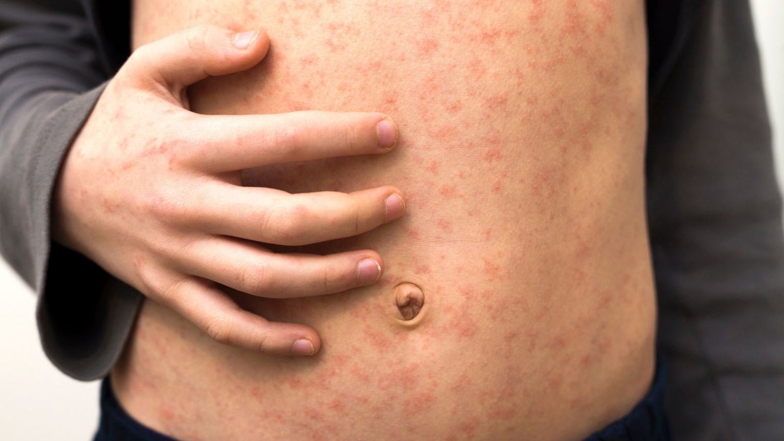 A child bears red spots after contracting measles.