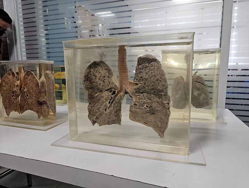 Mexico City'deki bir klinikte çeşitli solunum yolları rahatsızlıkları nedeniyle hayatını kaybetmiş kişilerin akciğerleri sergileniyor.