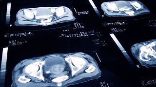 Prostate cancer slides are shown.