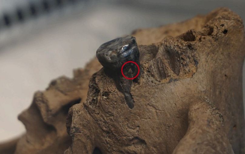 The red dot shows the spot dental calculus on the Harbin tooth, from where mtDNA was captured and sequenced from the skull.