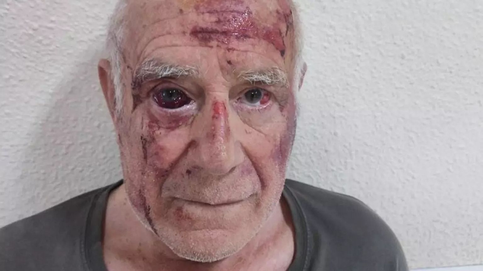 La paliza que recibió el vecino de 67 años de Torre Pacheco.