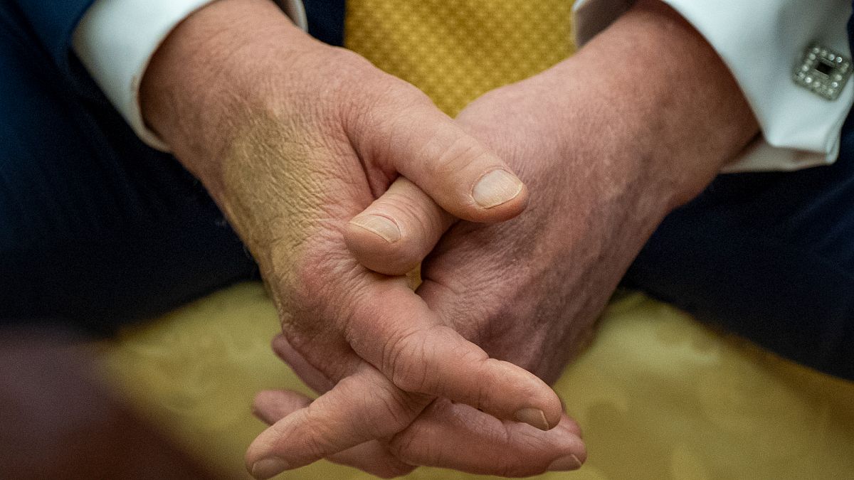 Trump diagnosed with chronic venous insufficiency after checks for lower leg swelling