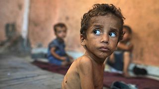کودک ۲ ساله مبتلا به سوءتغذیه، روز چهارشنبه، ۲۳ ژوئیه ۲۰۲۵، در خانه خانوادگی خود در اردوگاه پناهندگان شطی در شهر غزه 