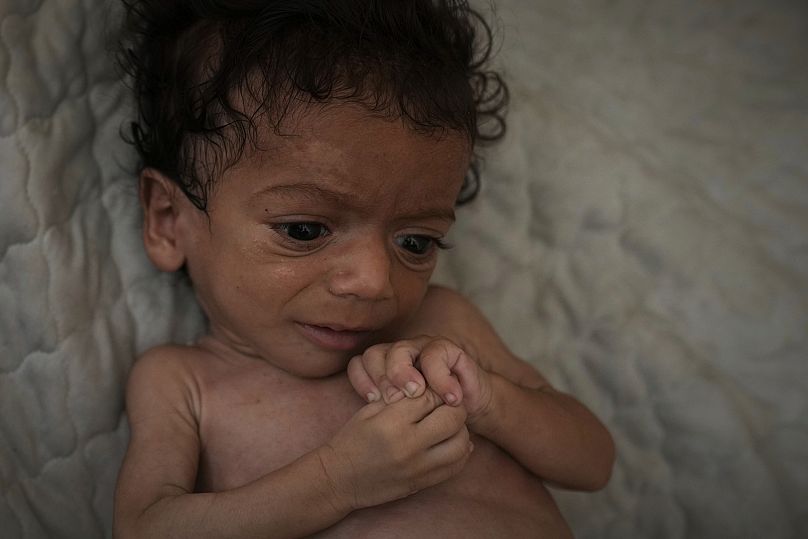 Seven-month-old Salem Awad, suffering from severe malnutrition, lies on a mattress for a picture at his family's tent in Gaza City, 28 July 2025. 